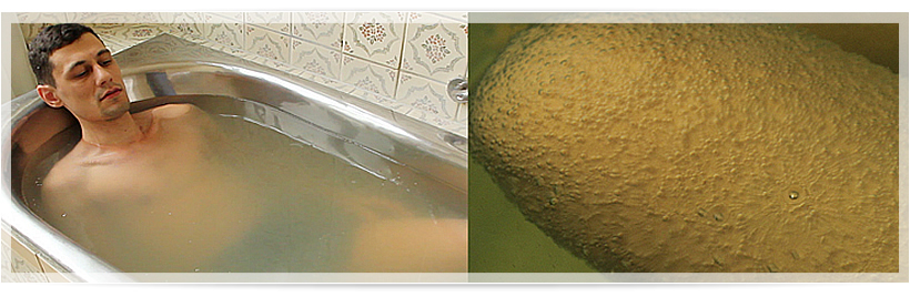 Абсолютно протипоказані вуглекислі ванни при тривалих нападах стенокардії і значному атеросклерозі мозкових і коронарних судин