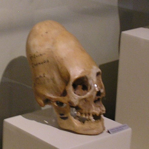 Деформовані черепа з музею Паракаса, Іка
